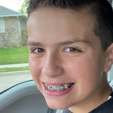 Getting braces at any time is a unique and memorable experience. Not  knowing you're getting braces and being surprised day-of, even more so.  Throw