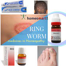 Ring Worm Remedies That Act Fast Are Safe And Side Effect Free Homeopathy Medicine Homeopathy Homeopathy Treatment
