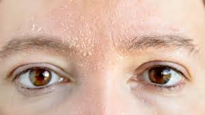 Image result for Dry Skin
