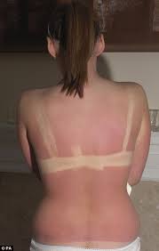 girl 14 suffers first degree burns on 70 of her body after spending just 19 minutes in unmanned tanning booth daily mail online