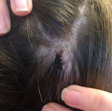 Pilar cysts may be inherited as an autosomal dominant trait with incomplete penetrance. Lasaderm Clinic Sebaceous Cyst Removal Tracy Kiss
