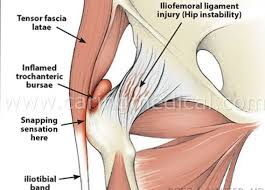 Image result for Snapping Hip