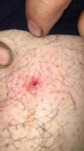 What do ingrown hairs look like? Popped An Ingrown Hair On My Boyfriends Leg And It Left A Hole Popping