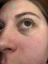 Ho do I get rid of sebaceous filaments