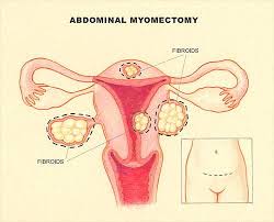 The majority of women will spend about 1 night in the hospital followed by 2 to 4 weeks of recovery time. Find Best Hospital For Myomectomy Uterine Fibroid Removal Treatment Cost Of Myomectomy Uterine Fibroid Removal In India