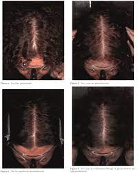 It can also have hormonal effects by blocking the action of androgens, male hormones, that are normally produced by women in low levels. Spironolactone For Hair Growth 2021 Guide Hairguard
