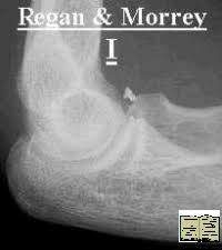 Image result for Coronoid Process Fracture