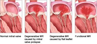 Mitral Clip Video Mitral Valve Mitral Valve Regurgitation Heart Surgery