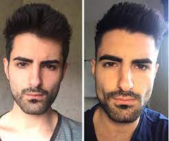 Prominent and defined cheek bones can be created with implants and fillers. M 24 5 11 169 Lbs I Posted A Picture Half A Year Ago And Want To Show My Progression I Worked On My Eyebrows And Still Working On More Hollow Cheeks What Is Your Opinion