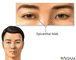 In asians it is normal, but in caucasians it may indicate an underlying syndrome. Epicanthal Folds Information Mount Sinai New York
