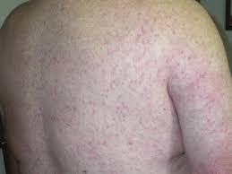 West nile fever is an infection by the west nile virus, which is typically spread by mosquitoes. Diffuse Maculopapular Rash Associated With West Nile Virus Infection Download Scientific Diagram