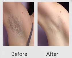 The most convincing armpit laser hair removal before after pictures would be those showing a successful removal of the 5 o'clock shadow gained from shaving. Laser Hair Removal Information Fleur T