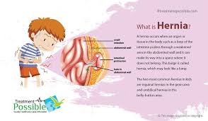 Image result for Inguinal hernia child