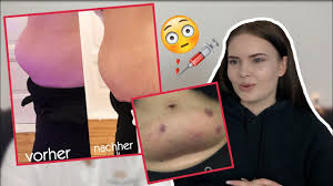 2 kilo weg in nur 24 stunden! Omg Ich Habe Es Getan Fett Weg Spritze Youtube