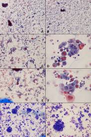 Refers to the study of cell structure and how cells function. Case N 35 Pleural Effusion Mesothelioma Cytology Blog Site