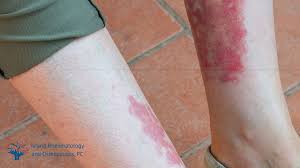 Image result for Vasculitis