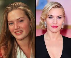 Kate winslet has long been opposed to hiding or retouching what hollywood deems physical imperfections onscreen, and her latest role in mare of easttown is no exception. Pin On Celebrity Cosmetic Surgery