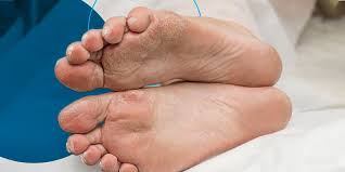 Image result for diabetic toes