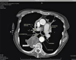 We found 7 dictionaries with english definitions that include the word thoracic ducts: Acquiring And Improving Skills In Diagnostic Endosonography Springerlink