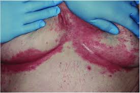 Image result for Intertrigo under breasts