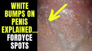 Doctor explains FORDYCE SPOTS / GRANULES - small white spots or pimples on  the penis... - YouTube