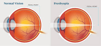 Mar 13, 2017 · dizziness and vertigo are among the most common symptoms causing patients to visit a physician (as common as back pain and headaches). Presbyopia Causes Symptoms And Treatment Readers Com