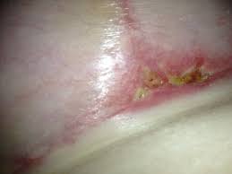 Maybe you would like to learn more about one of these? Is My Breast Incision Infected Photos