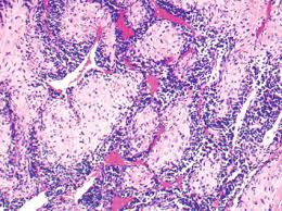 Image result for Chondrosarcoma