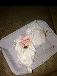 صرصار حي بساندويتش شاورما يدخل فتاة مستشفى رماح المركزي