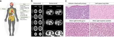 The strongest risk factor for developing skin cancer is ultraviolet (uv) ray exposure, typically from the sun. Multi Site Clonality Analysis Uncovers Pervasive Heterogeneity Across Melanoma Metastases Nature Communications