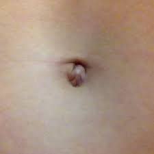 Ohne chirurgische intervention verlaufen strangulierte hernien immer tödlich. Nabelbruch Oder Nicht Bauch