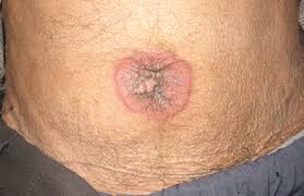 Image result for lump