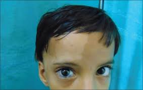 Image result for nevus sclerae