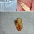 Painless Wisdom Tooth Extraction/Removal Dentist in Dwarka product image