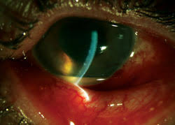The clinical indication/medical necessity for the bevacizumab injection, the actual dosage of bevacizumab given, site of injection and route of administration, test results to firmly establish diagnosis by fluorescein angiogram or optical coherence tomography (oct), for individuals Distinguishing Infection Post Intravitreal Injection