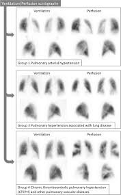 Image result for Ventilation Perfusion Scan
