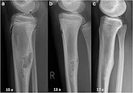 In fact, mast cell tumors are typically diagnosed after a pet owner takes their dog to the veterinarian because they've felt a lump in or under the skin. Bone Tumor Wikipedia