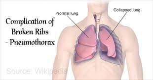 Rib cages are corpse parts that are used to obtain the base forms of part 7 stands. Broken Or Bruised Ribs Types Causes Symptoms Risks Complications Diagnosis Treatment Prevention