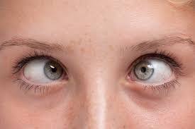 Strabismus &ndash; Royal Spanish Center