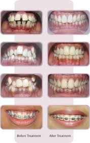 Pin By Aubert Nguyen Orthodontics On Teeth Orthodontics Dental Braces Dental Retainer