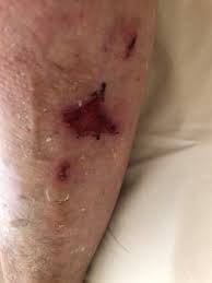 Image result for Skin Tear