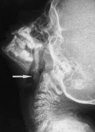 However, radiographs are also an important tool for use in dogs diagnosed with or suspected of having cancer. X Ray Of The Soft Tissue Neck Lateral View Showing The Mass Arrow Download Scientific Diagram