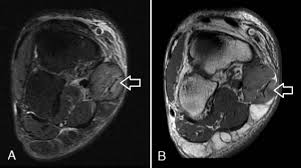Dr yuranga weerakkody ◉ and dr geon oh et al. Acute Exertional Medial Compartment Syndrome Of The Foot In A Teenager Sciencedirect