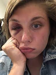 Aug 23, 2018 · digg. I Got A Black Eye And It Taught Me A Thing Or Two About Sexism By Madeline Howard Medium