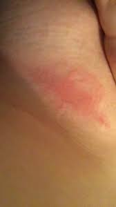 Intertrigo refers to a type of inflammatory rash of the superficial skin that occurs within a person's body folds. Under Breast Intertrigo Page 1 Babycenter