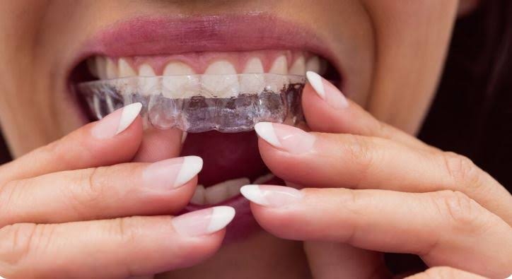 Clear Aligners product image