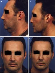 Serendipity in Ultimate Neck Lift Correction