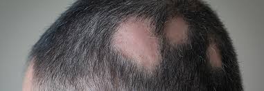 J am acad dermatol 1985; Januskinase Inhibitor Wirkt Gegen Alopecia Areata Medical Tribune