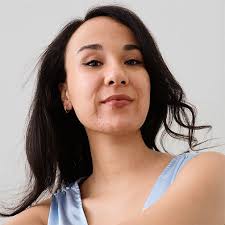 Eczema, Acne & Rosacea: 3 Influencers Talk Skin Positivity