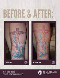 Http Www Cumberlandlaser Com Pages Procedures Laser Ipl Treatments Tattoo Removal Tattoo Removal Cost Laser Tattoo Laser Tattoo Removal